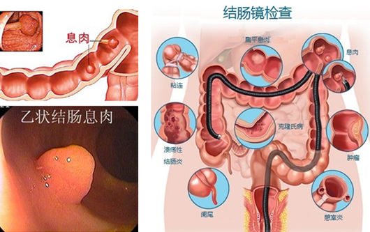萎縮性胃炎真的“很嚇人”？看完這“七個事實”你就明白了